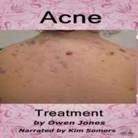 Jones Owen. Acne Treatment