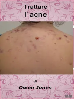 Trattare L&prime;Acne - Owen Jones