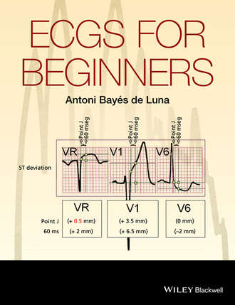 Antoni Bay?s de Luna. ECGs for Beginners