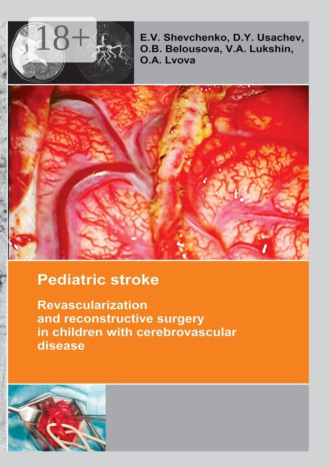 Обложка книги «Pediatric stroke. Revascularization and reconstructive surgery in children with cerebrovascular disease»