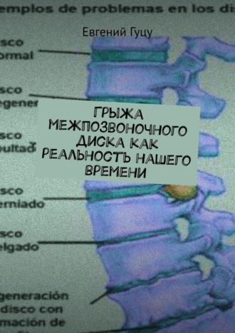 Обложка книги «Грыжа межпозвоночного диска как реальность нашего времени»