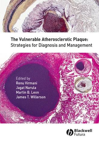 Renu  Virmani. The Vulnerable Atherosclerotic Plaque