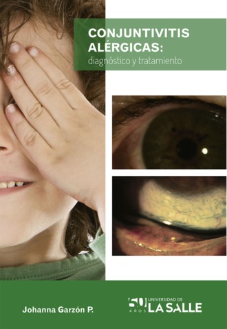 Sandra Johanna Garz?n Parra. Conjuntivitis al?rgicas