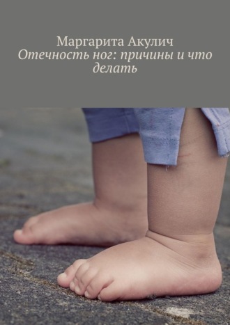 Маргарита Акулич. Отечность ног: причины и что делать