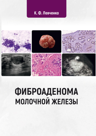 Обложка книги «Фиброаденома молочной железы»