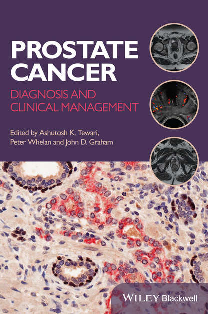 

Prostate Cancer