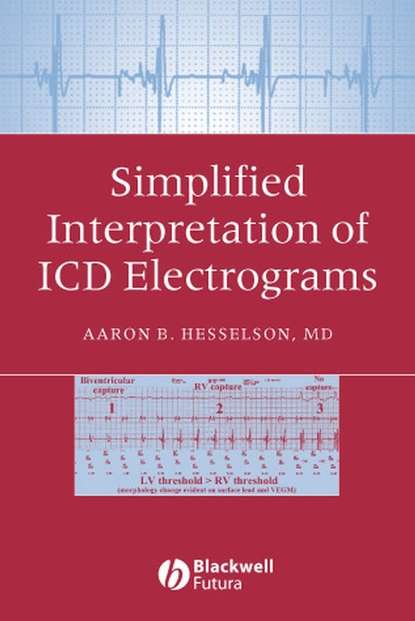 

Simplified Interpretation of ICD Electrograms