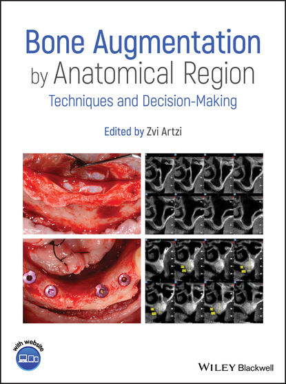 

Bone Augmentation by Anatomical Region