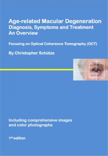 

Age-related macular degeneration
