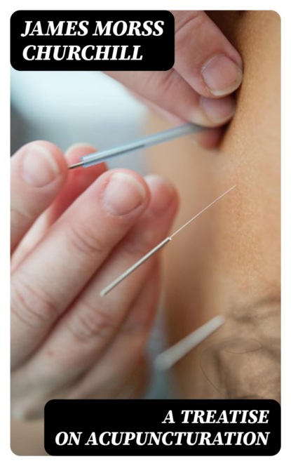 A Treatise on Acupuncturation