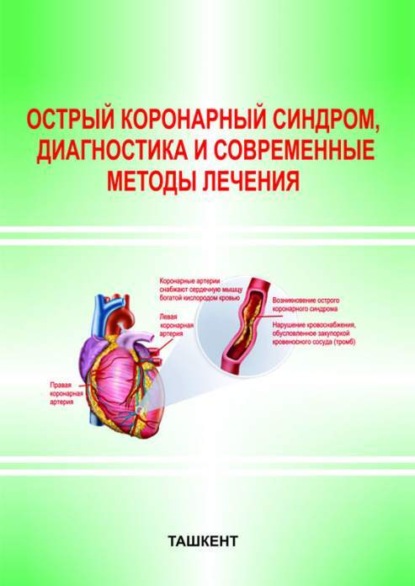 

Острый коронарный синдром, диагностика и современные методы лечения
