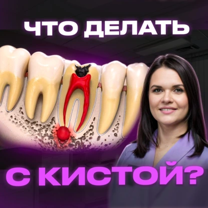 МОЖНО ЛИ СОХРАНИТЬ ЗУБ С КИСТОЙ? ЭТАПЫ ЛЕЧЕНИЯ КИСТЫ ЗУБА