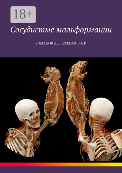 

Сосудистые мальформации