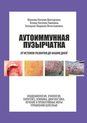 Аутоиммунная пузырчатка. От истоков развития до наших дней