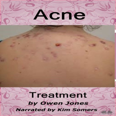 Acne Treatment