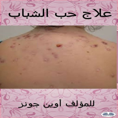 علاج حب الشباب
