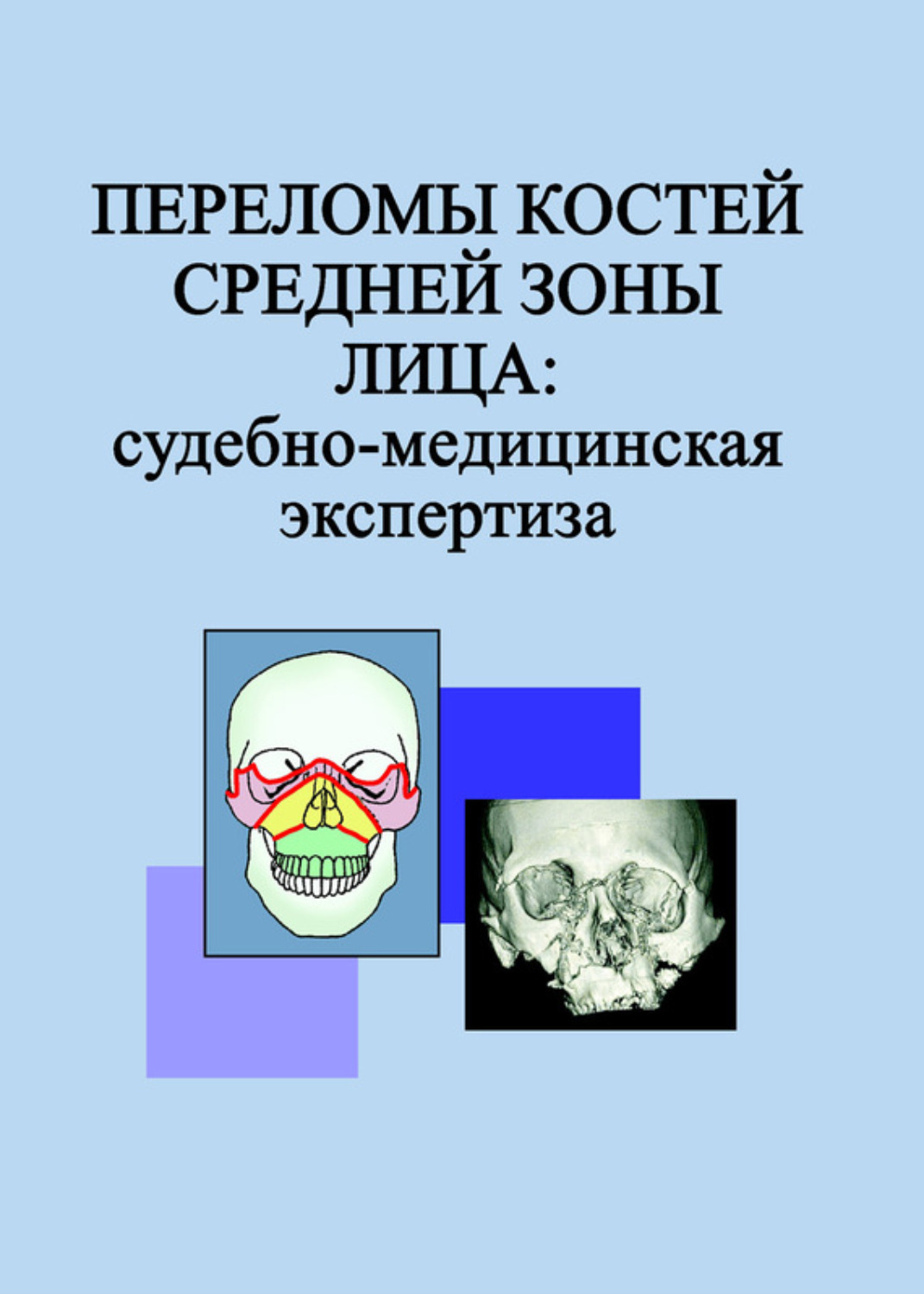 Обложка книги «Переломы костей средней зоны лица: судебно-медицинская экспертиза»