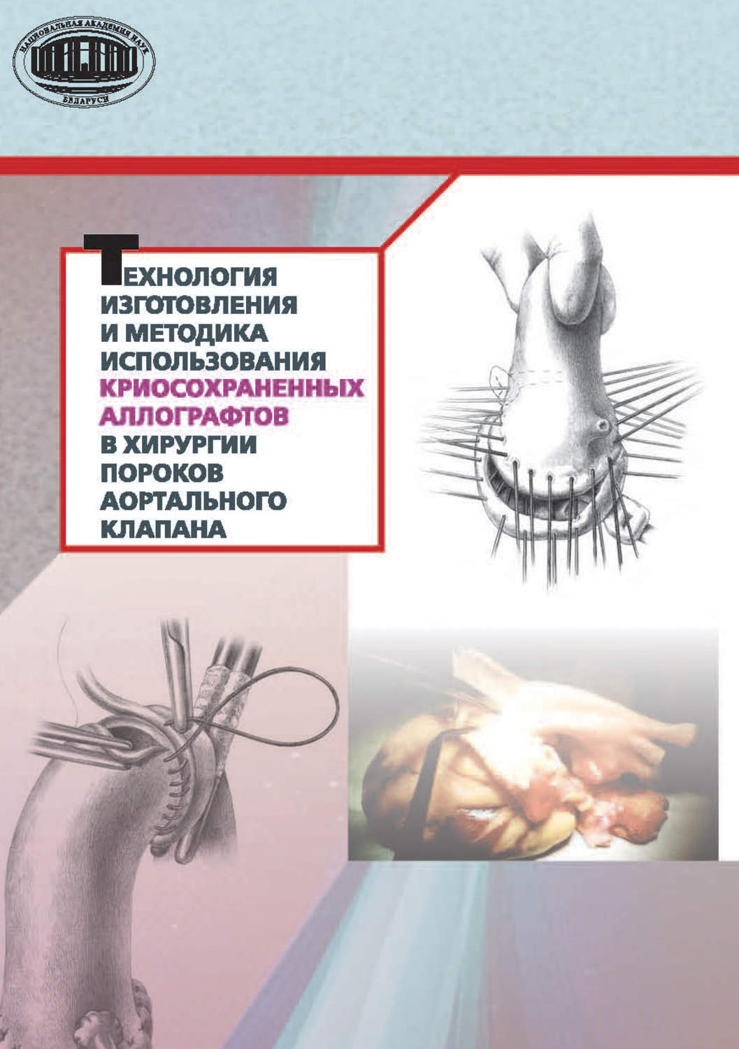 Обложка книги «Технология изготовления и методика использования криосохраненных аллографтов в хирургии пороков аортального клапана»