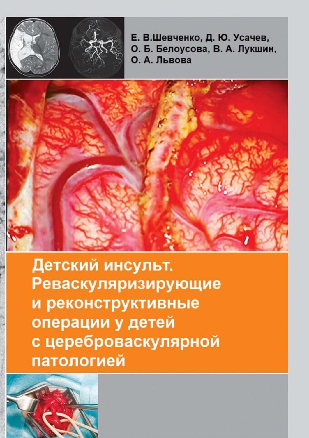 Обложка книги «Детский инсульт. Реваскуляризирующие и реконструктивные операции у детей с цереброваскулярной патологией»