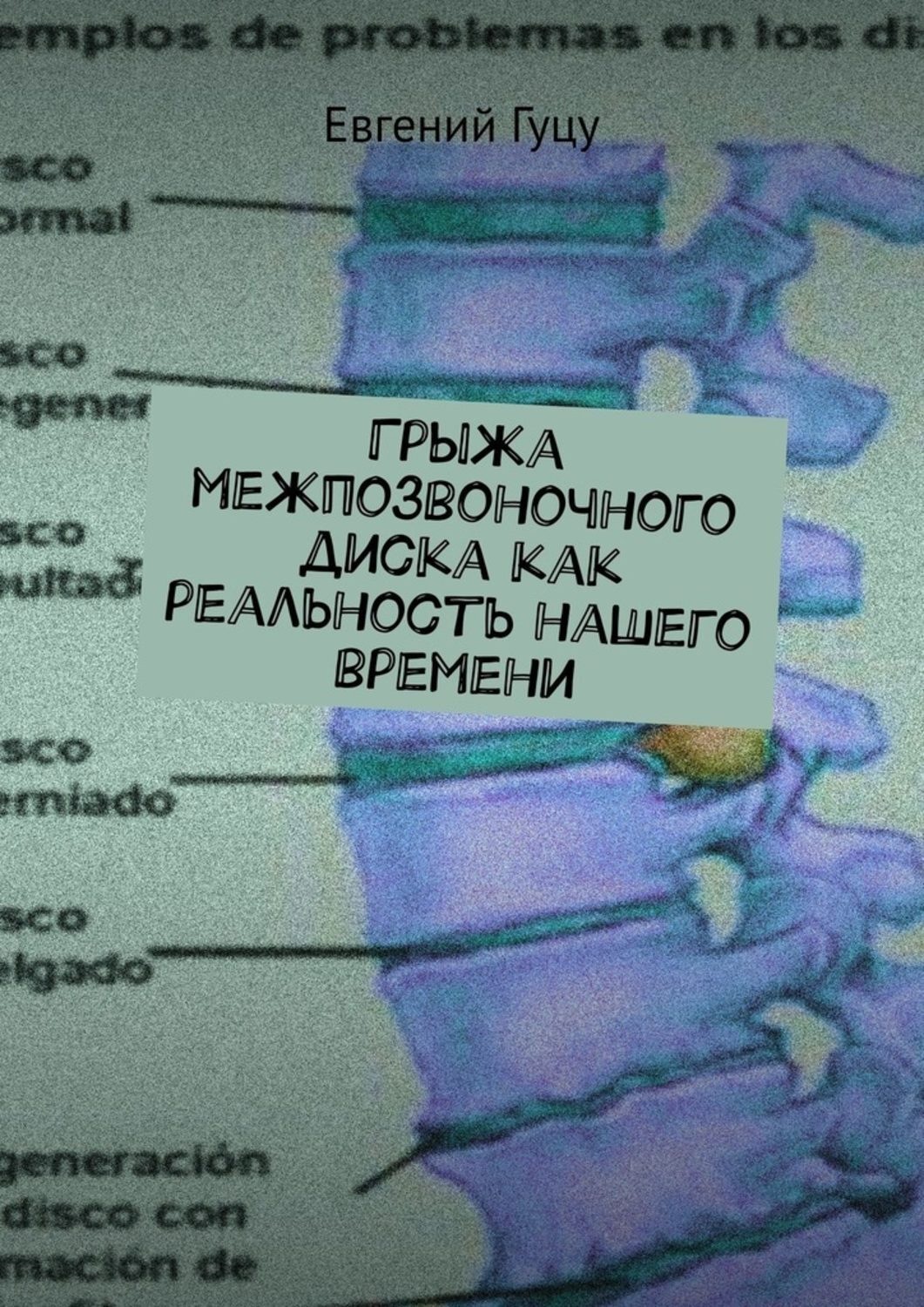 Обложка книги «Грыжа межпозвоночного диска как реальность нашего времени»