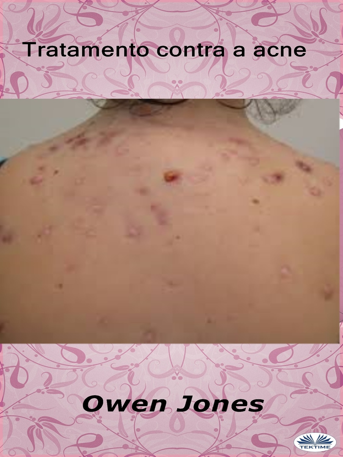 Обложка книги «Tratamento Contra A Acne»