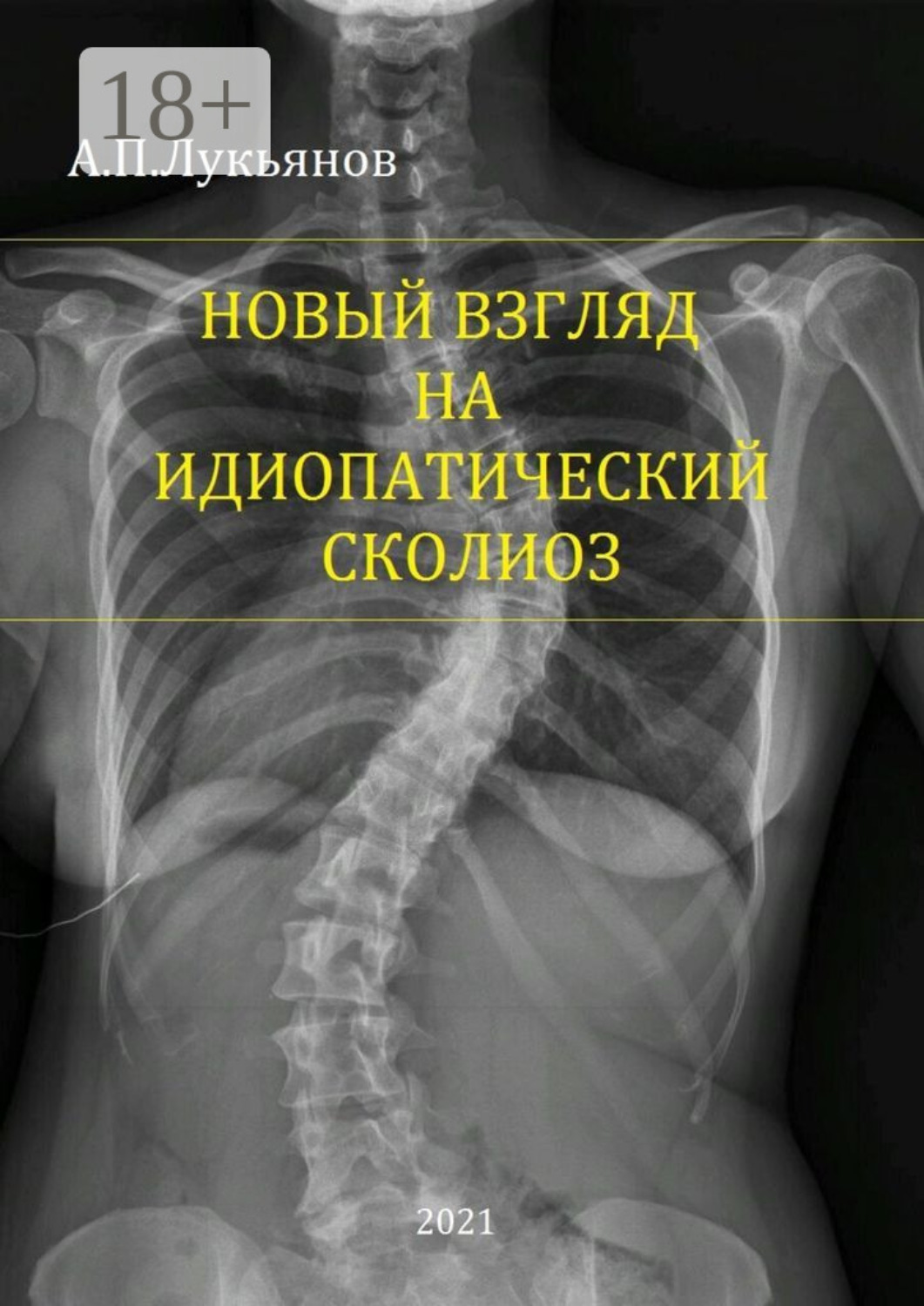 Обложка книги «Новый взгляд на идиопатический сколиоз»