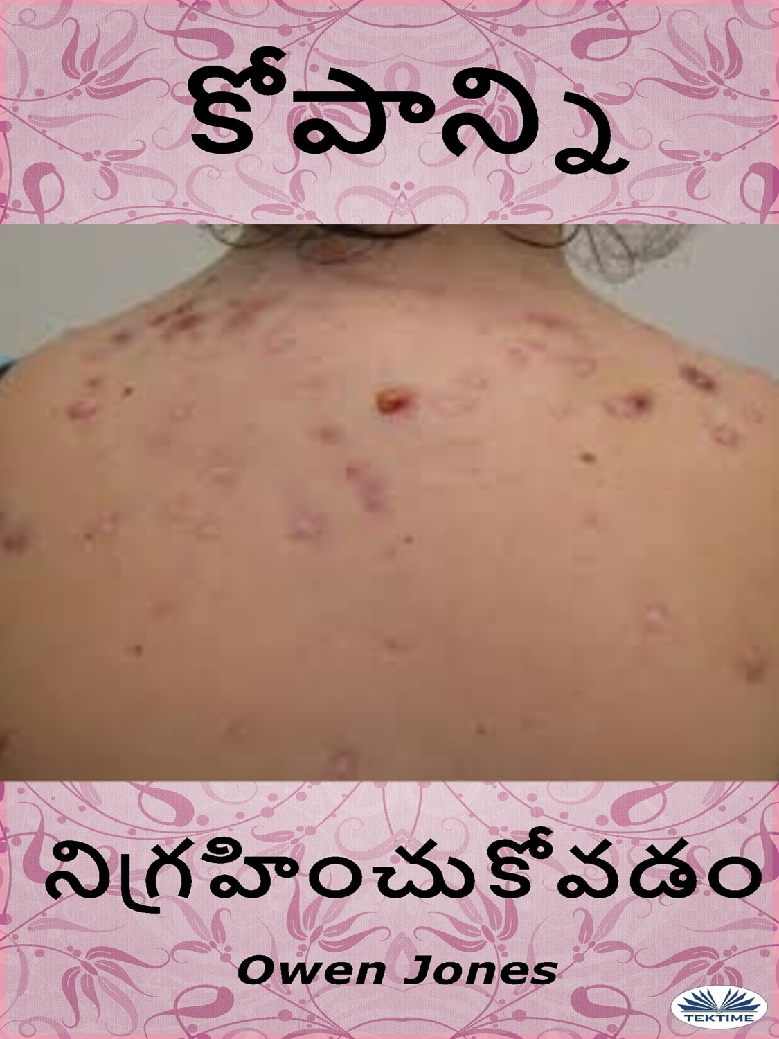 Обложка книги «ముఖ మొటిమల చికిత్స»