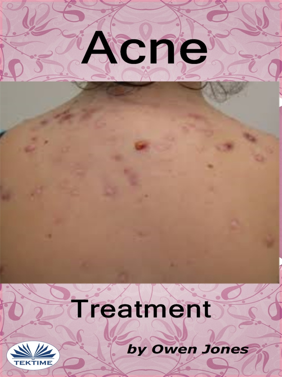 Обложка книги «Acne Treatment»