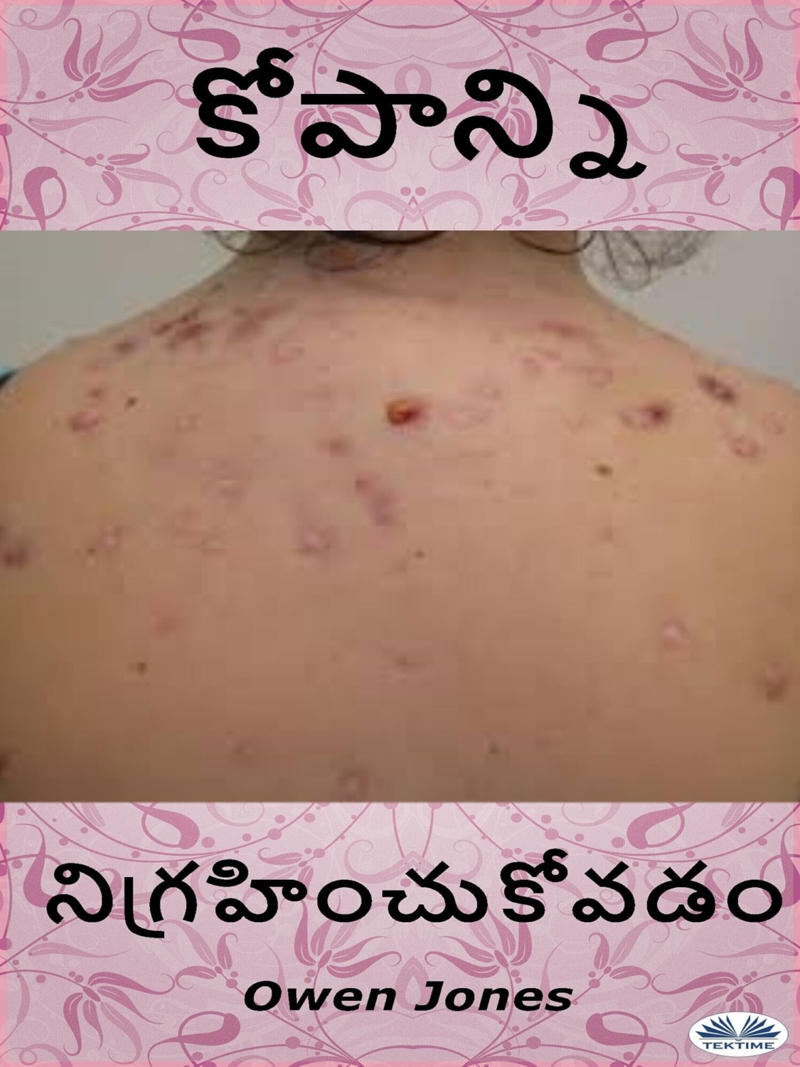 Обложка книги «ముఖ మొటిమల చికిత్స»
