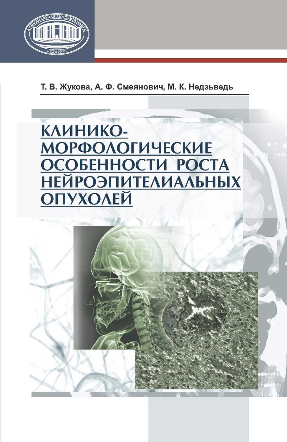 Обложка книги «Клинико-морфологические особенности роста нейроэпителиальных опухолей»