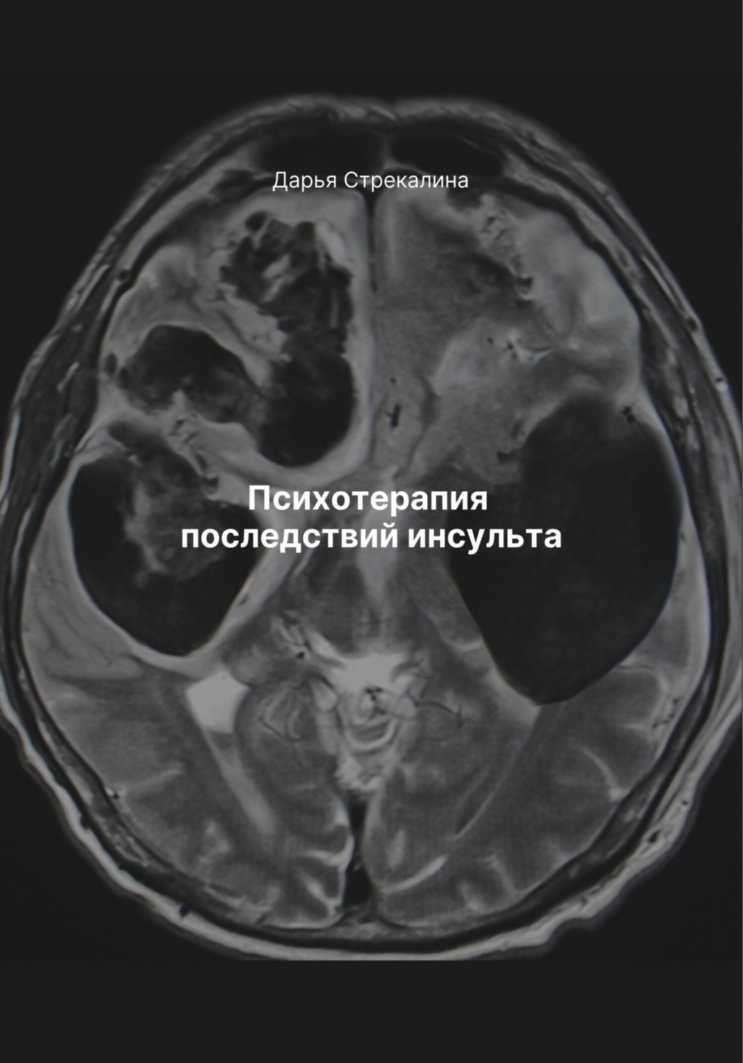 Обложка книги «Психотерапия последствий инсульта»