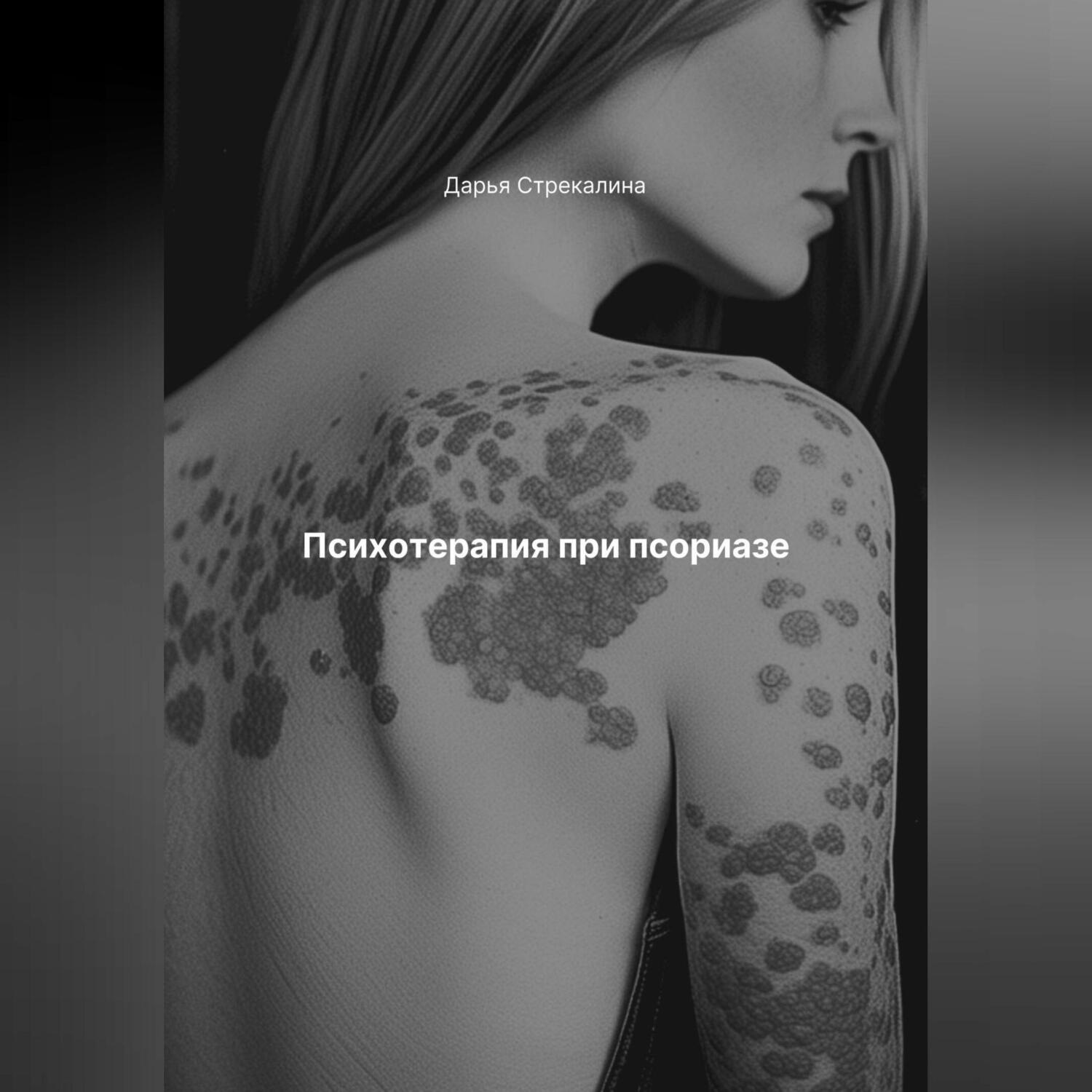 Обложка книги «Психотерапия при псориазе»