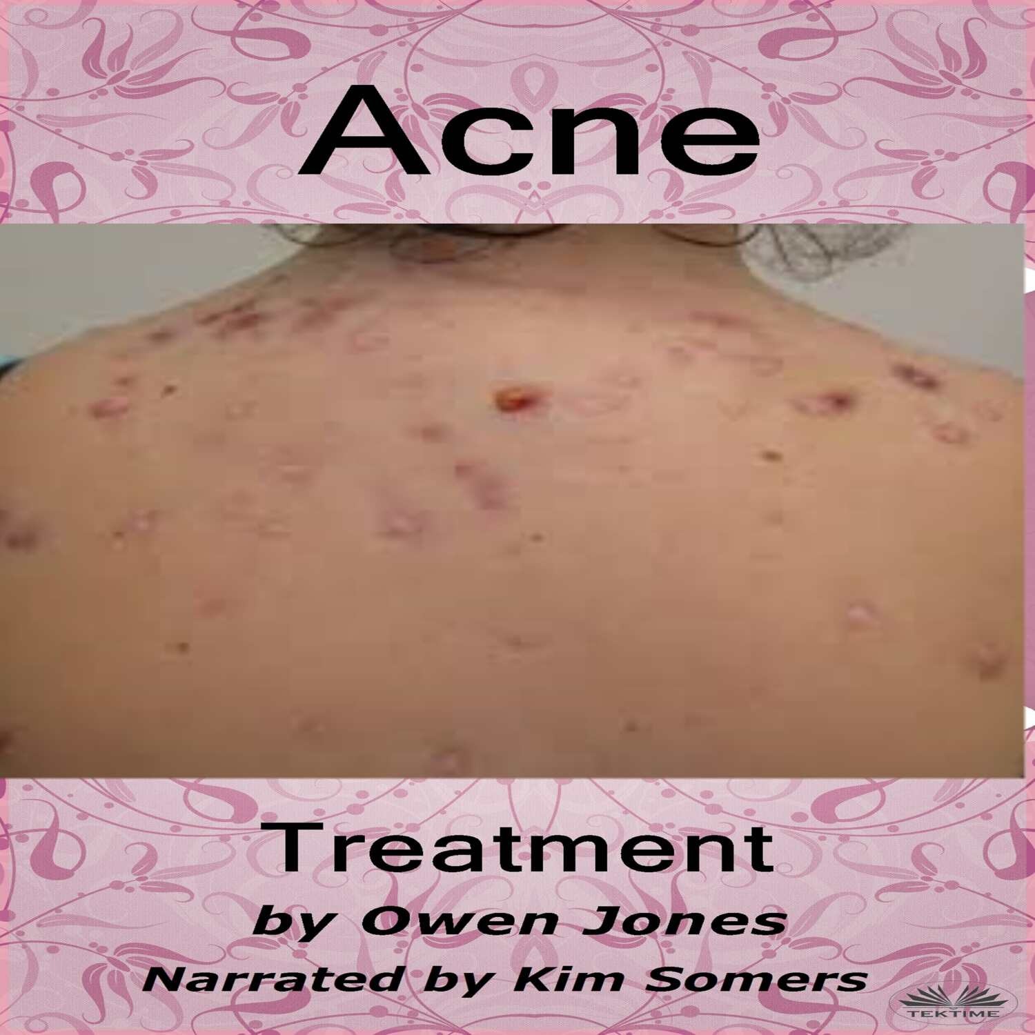 Обложка книги «Acne Treatment»