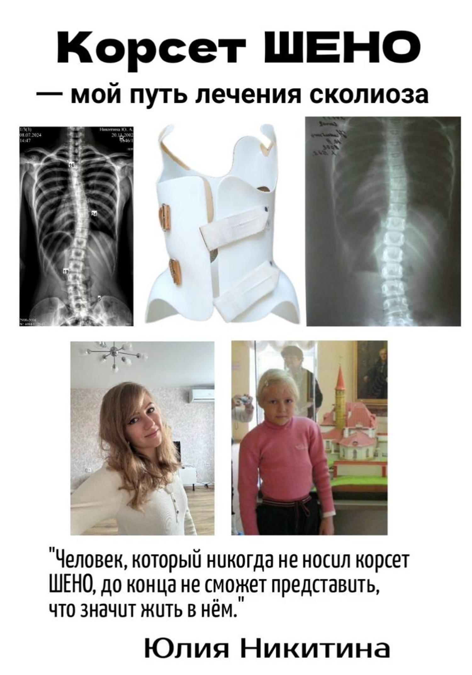Обложка книги «Корсет Шено. Мой путь лечения сколиоза»