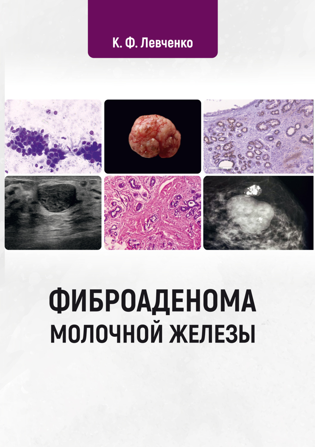 Обложка книги «Фиброаденома молочной железы»